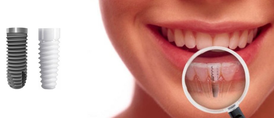 Best Dental Implants Treatment in Gurgaon Sector 80