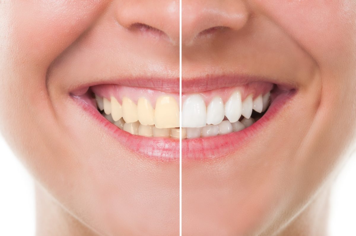 Best Teeth Whitening Treatment in Gurgaon Sector 80